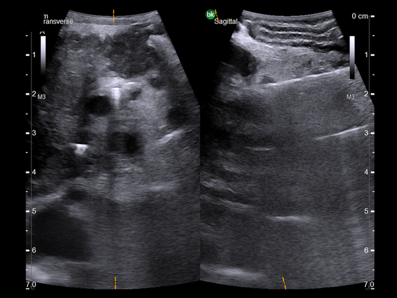 Pancreatic head mass, visualized with Biplane Transducer