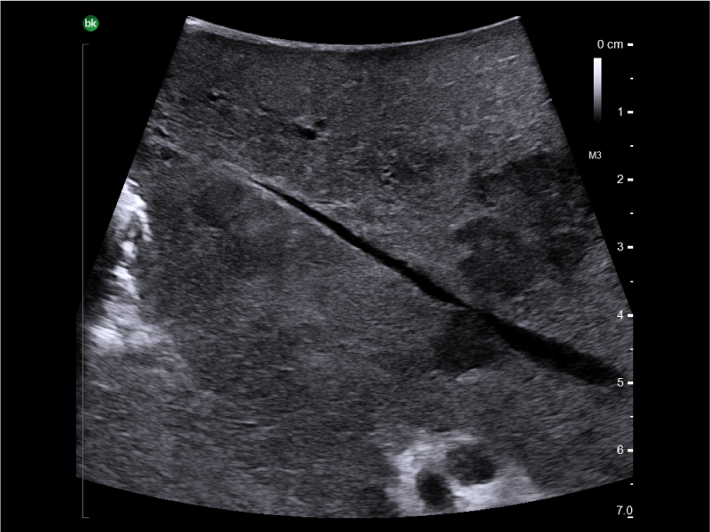 Liver mass, visualized with I-Shaped Transducer